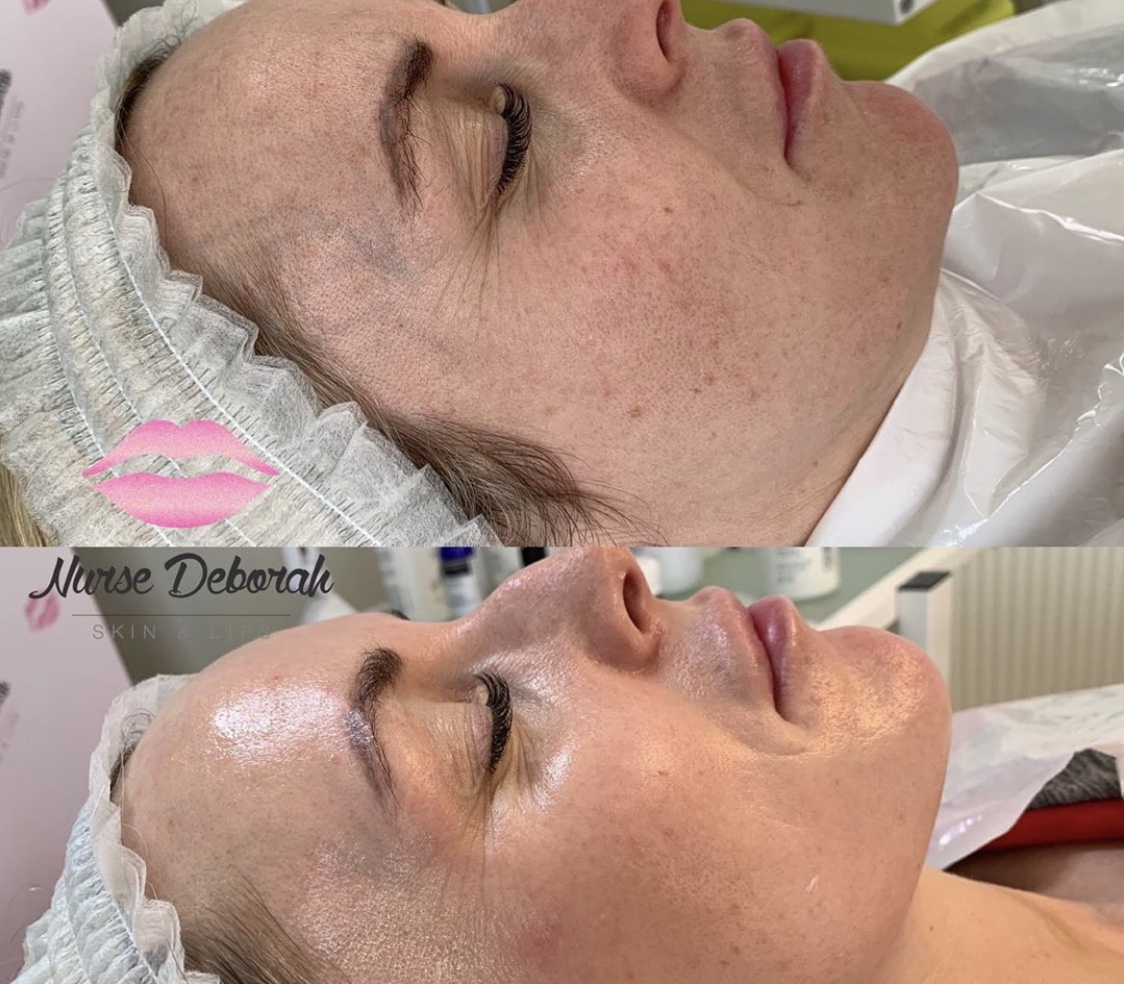 Dermaplaning and Radiant 30 peel
Dermaplaning and Radiant 30 peel
