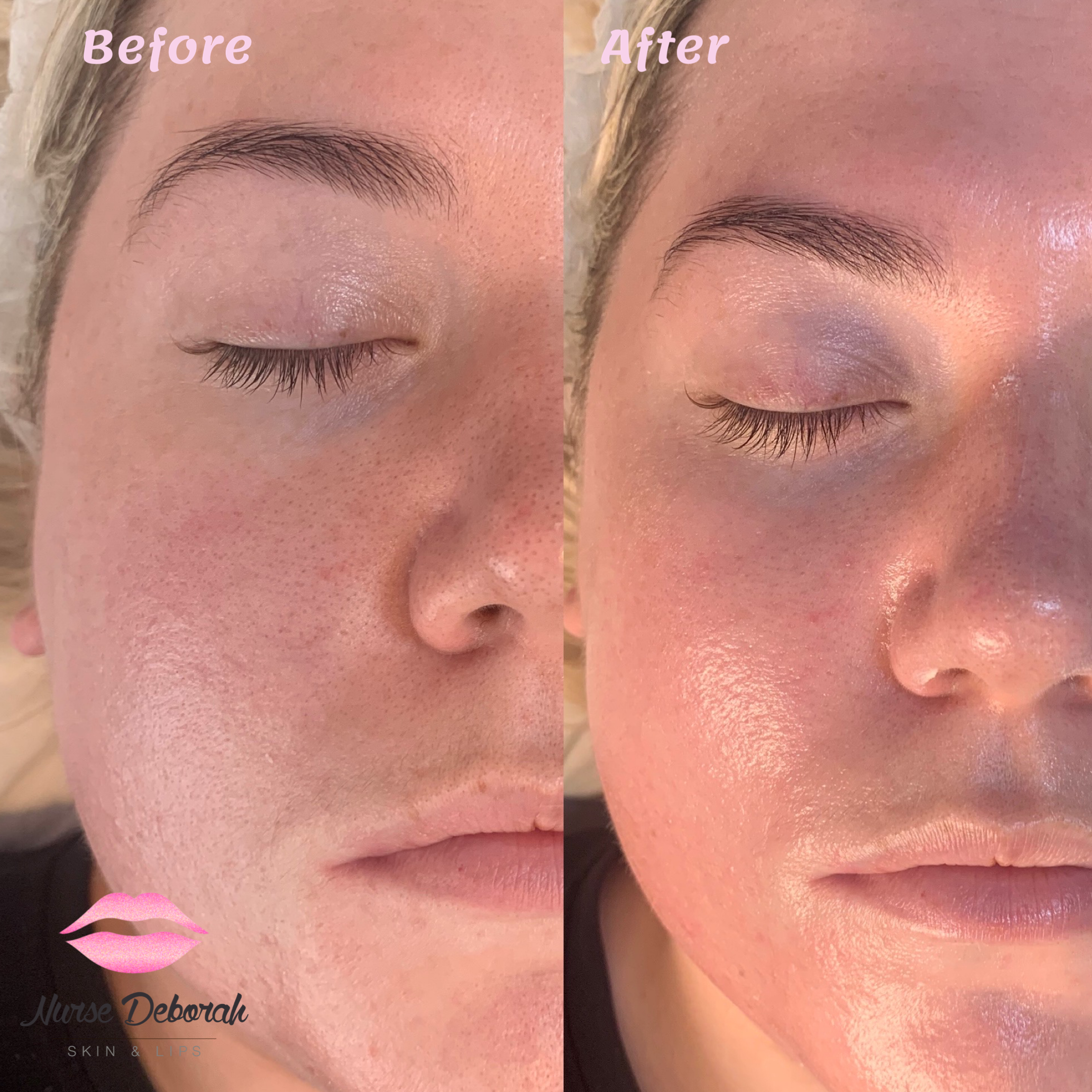 Alumier MD
Enzyme Retexturing treatment and Neo-Elegance Red light LED therapy (dull, dehydrated skin)
Alumier MD
Enzyme Retexturing treatment and Neo-Elegance Red light LED therapy (dull, dehydrated skin)