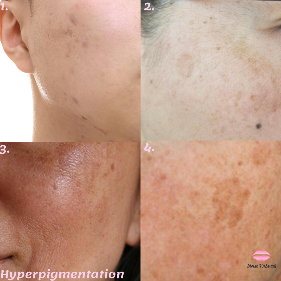 Pigmentation