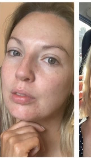 ACNE TREATMENT CORK after