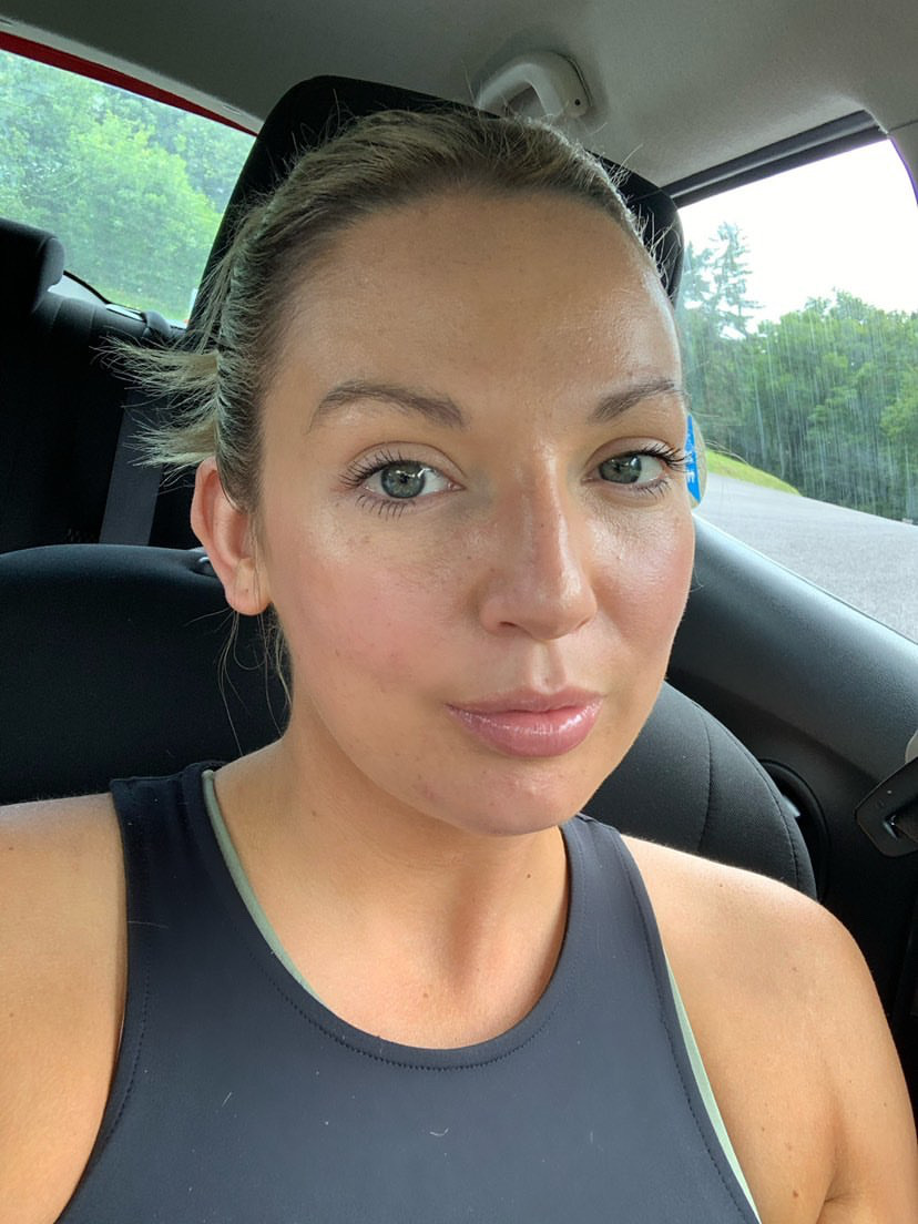 Naoimhs Acne Journey