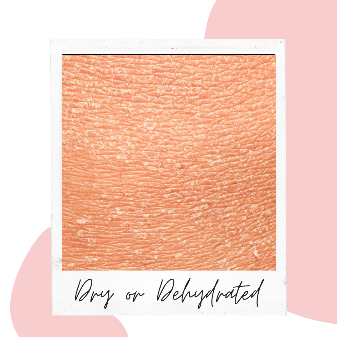 Dry or Dehydrated
